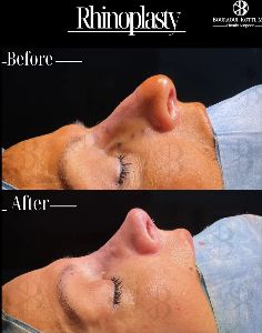 Rhinoplasty before and after clinical result