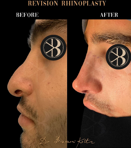 Rhinoplasty before and after clinical result