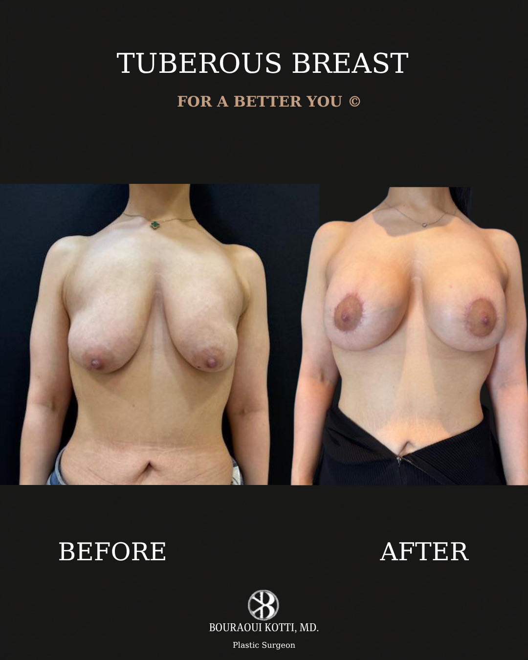 Tuberous and Tubular Breast Correction before and after clinical result