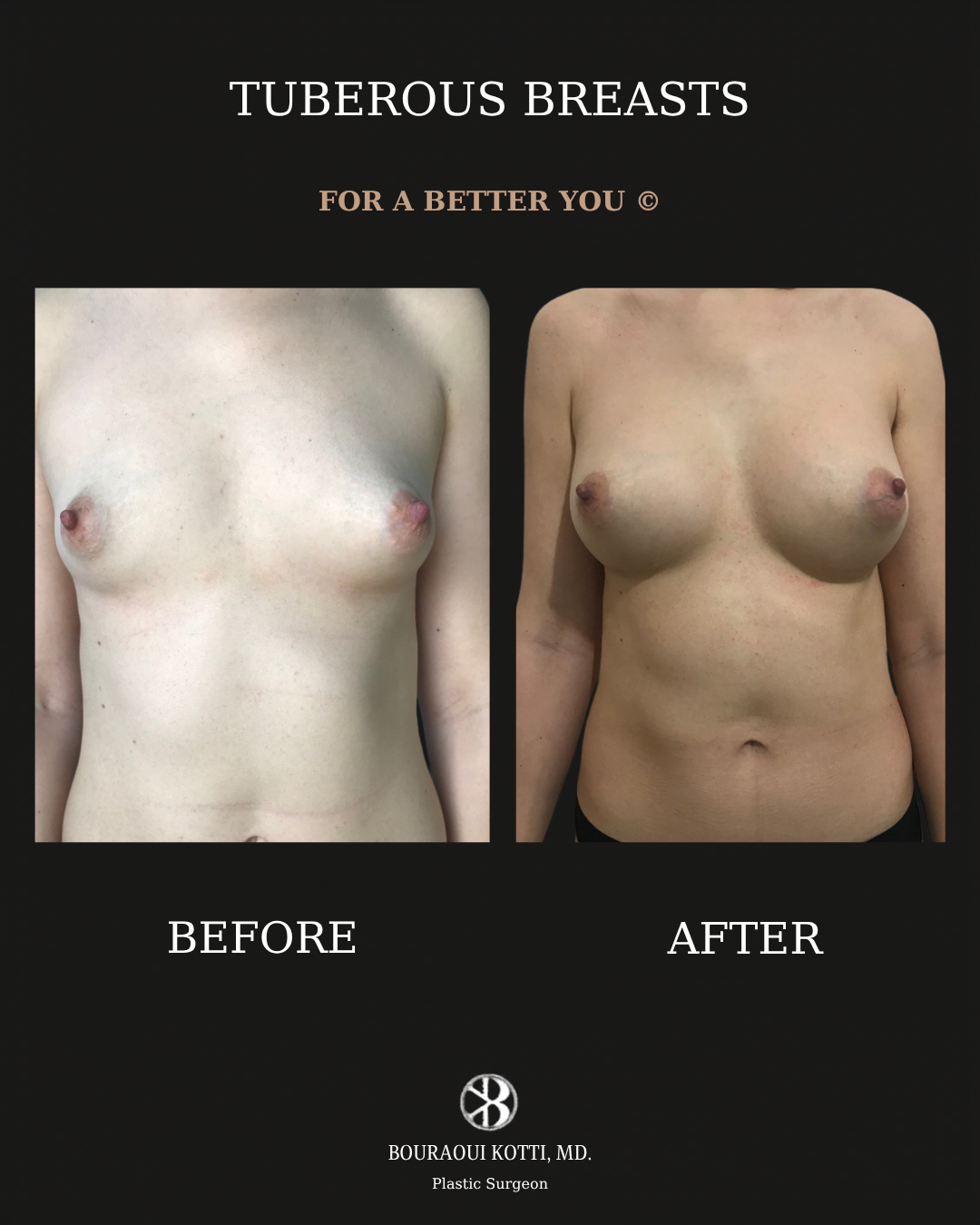 Tuberous and Tubular Breast Correction before and after clinical result
