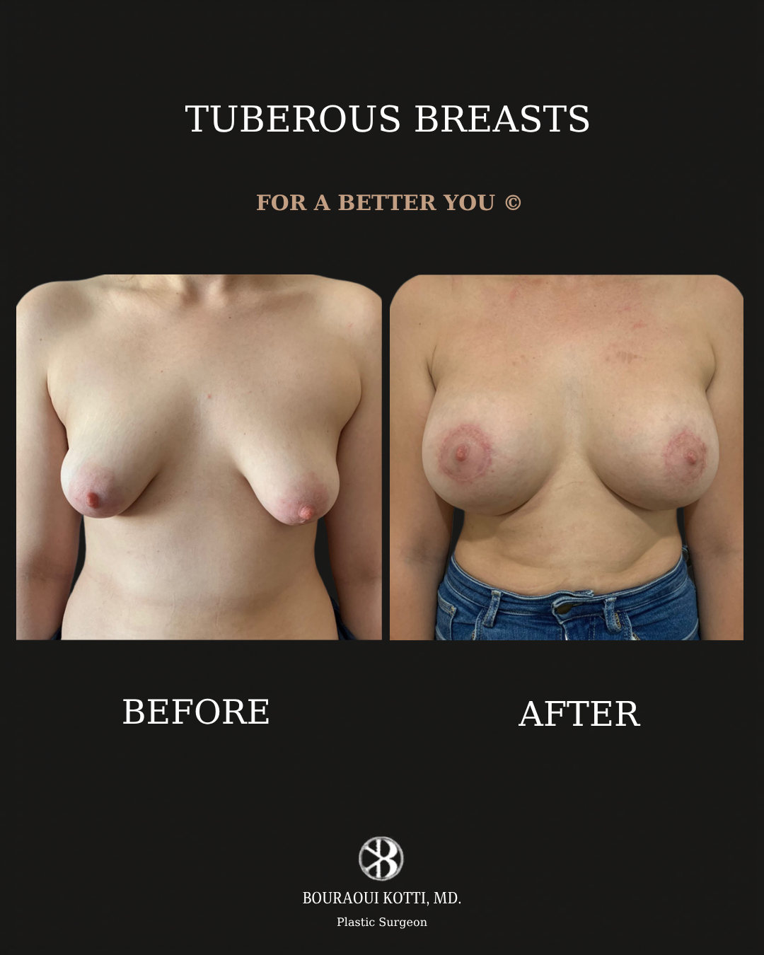 Tuberous and Tubular Breast Correction before and after clinical result