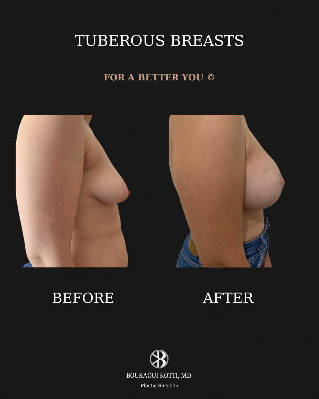 Tuberous and Tubular Breast Correction before and after clinical result