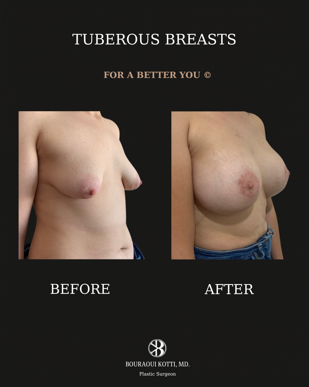 Tuberous and Tubular Breast Correction before and after clinical result