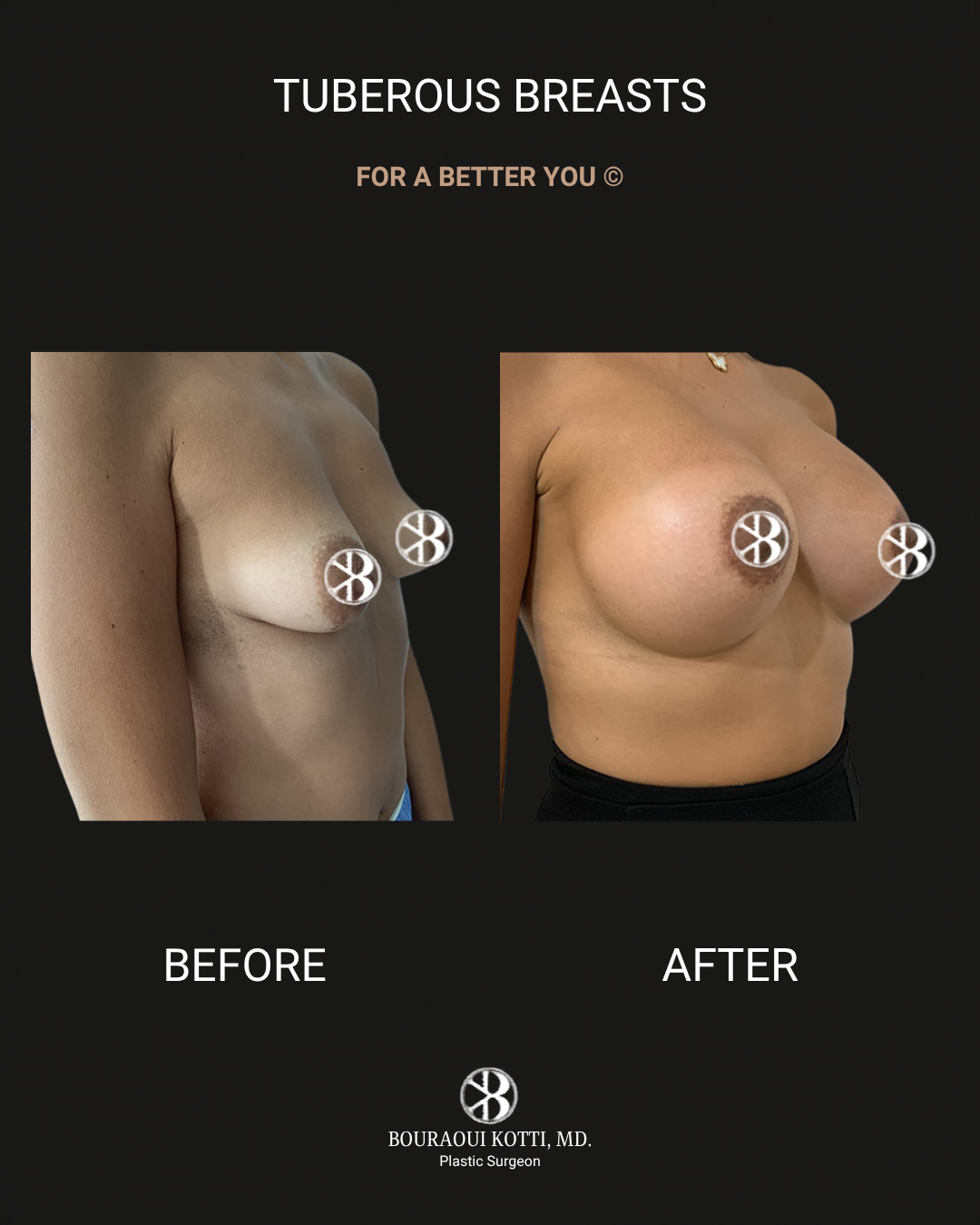 Tuberous and Tubular Breast Correction before and after clinical result