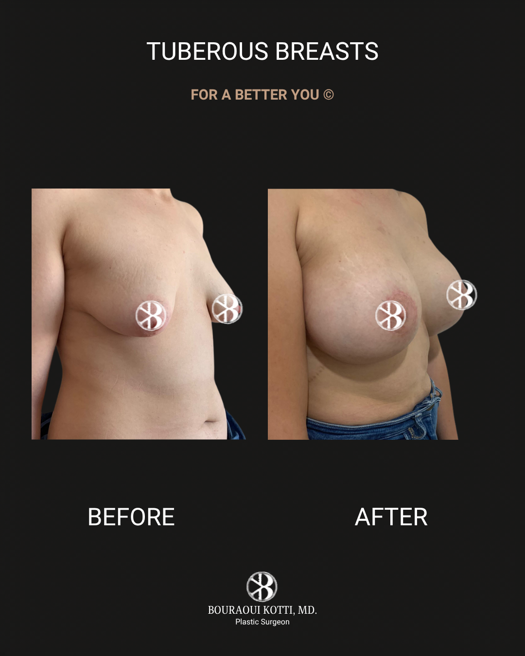Tuberous and Tubular Breast Correction before and after clinical result