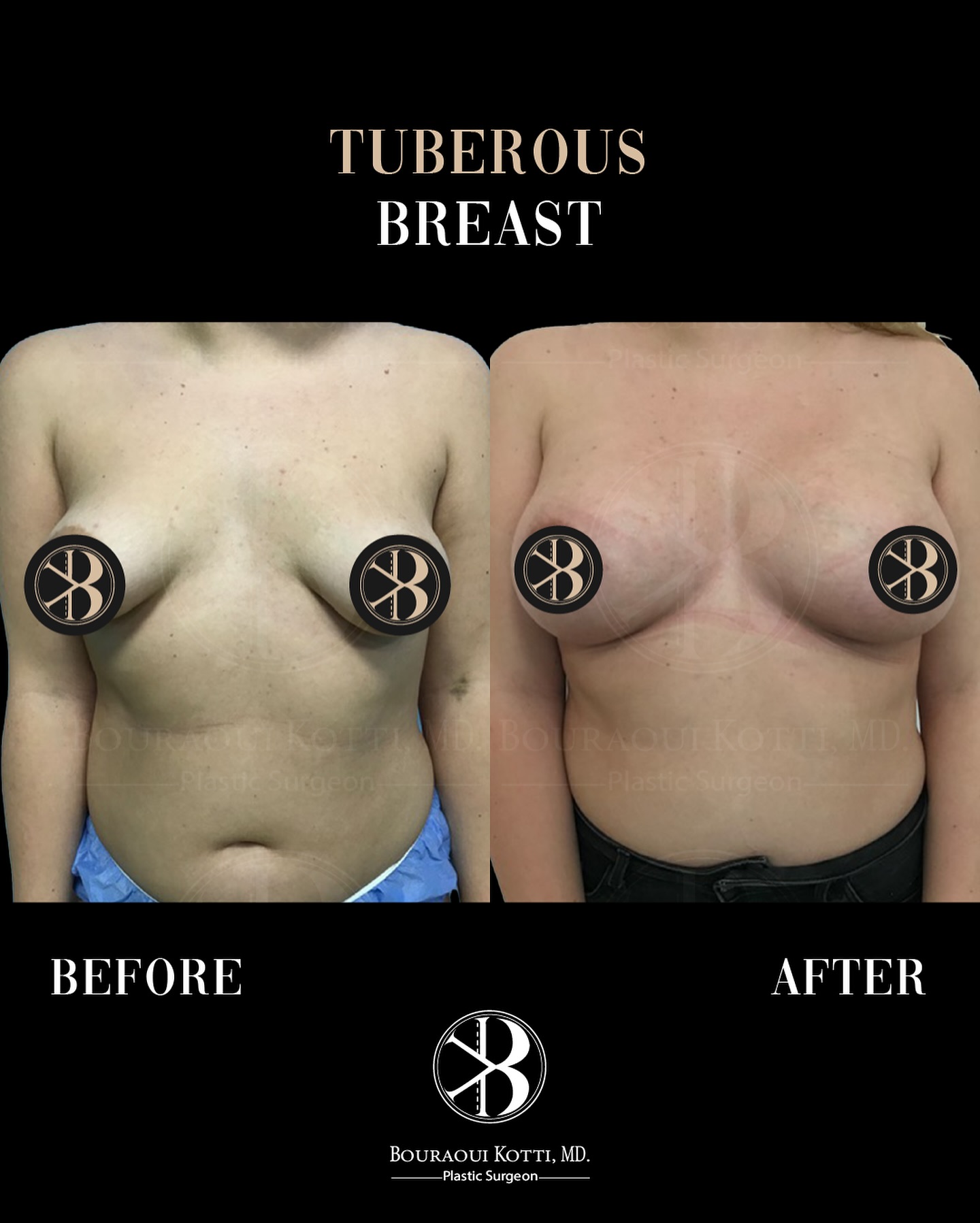 Tuberous and Tubular Breast Correction before and after clinical result