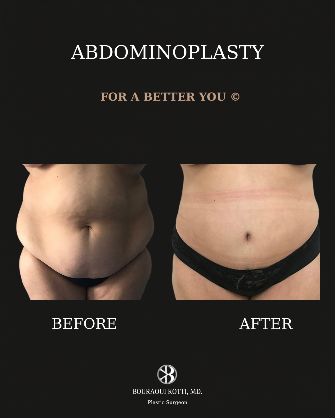 Tummy Tuck (Abdominoplasty) after Dubai