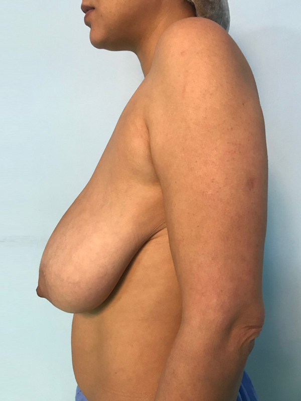 Breast Lift before Dubai — natural outcome | Dr. Kotti (4)