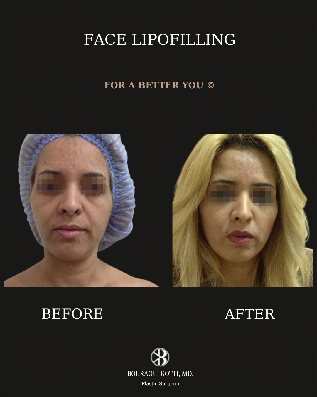 Lipofilling du Visage before Dubai