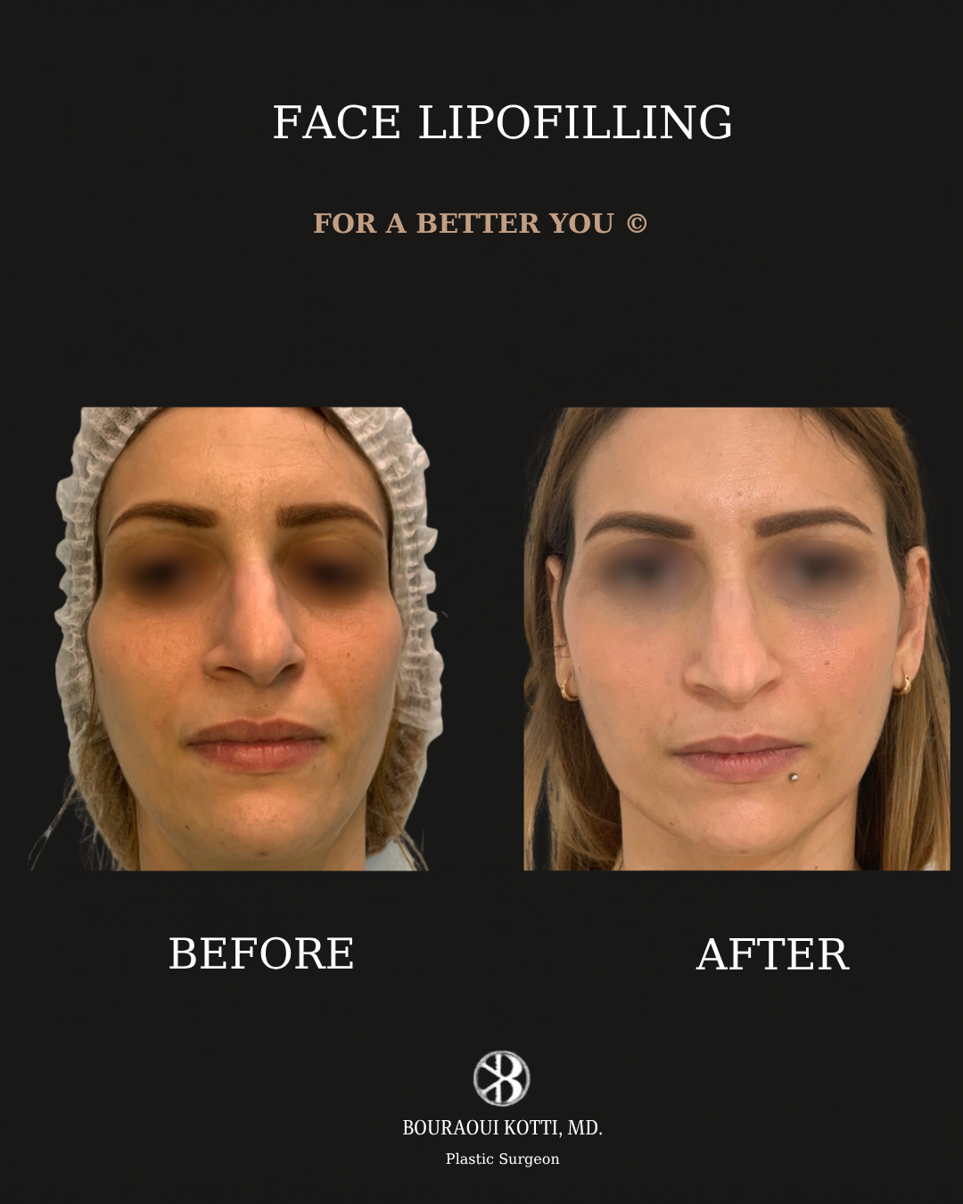 Lipofilling du Visage after Dubai