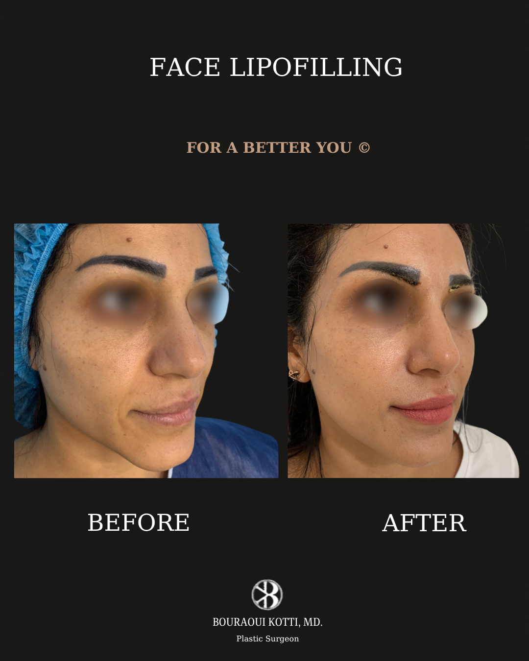 Lipofilling du Visage before Dubai