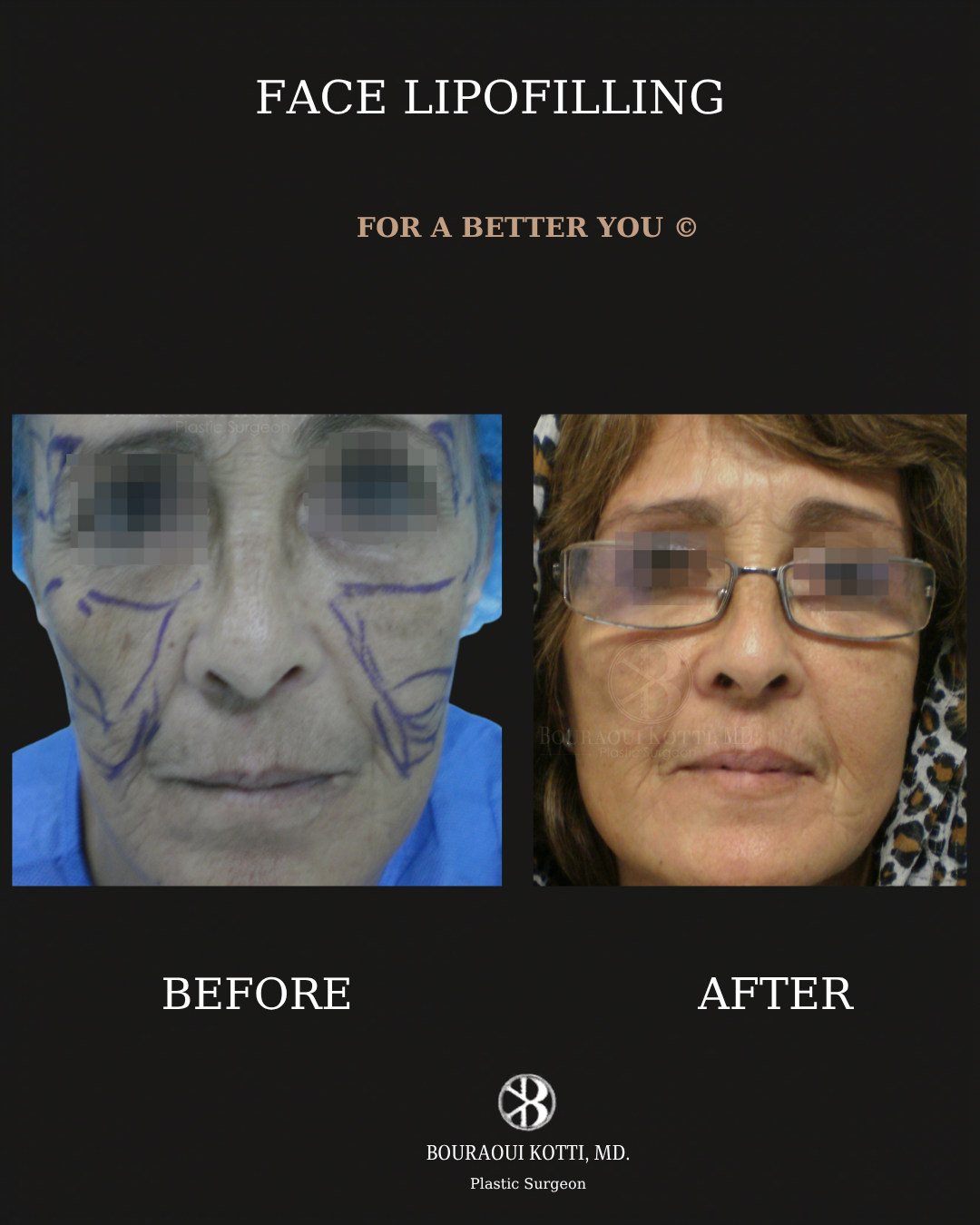 Lipofilling du Visage after Dubai