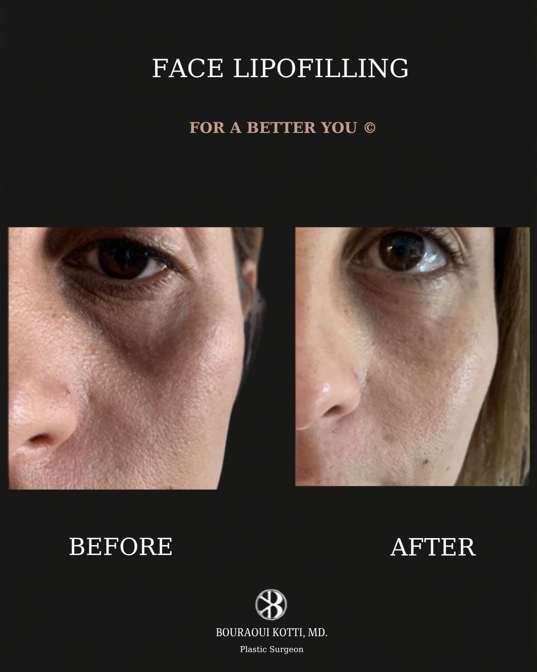 Lipofilling du Visage before Dubai
