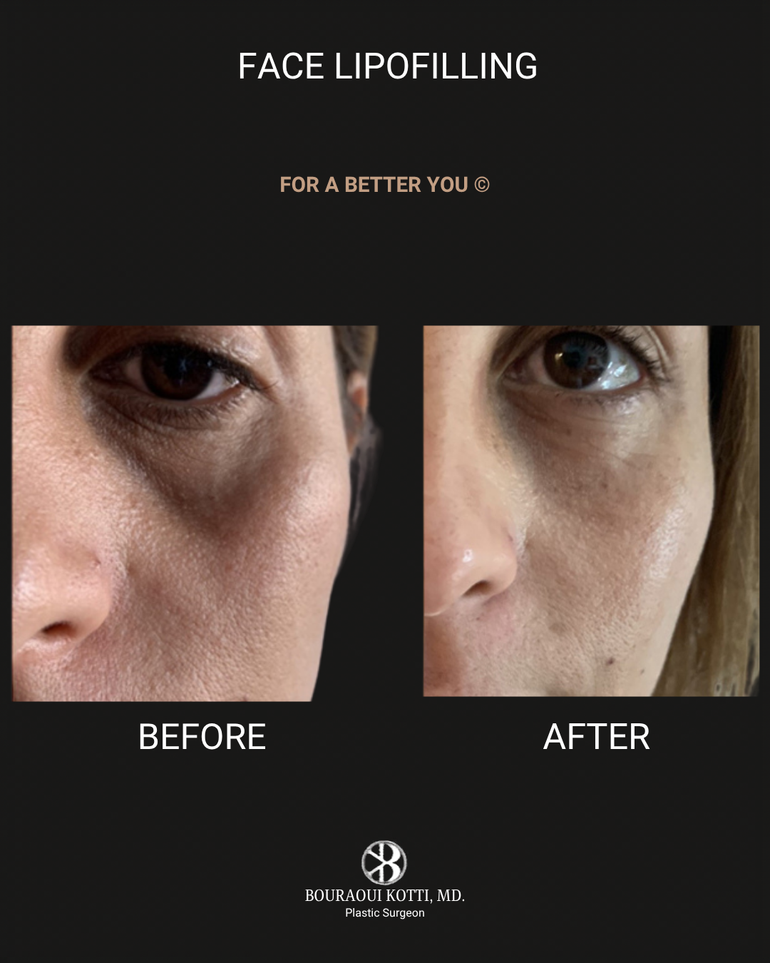 Lipofilling du Visage after Dubai