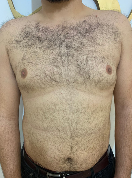 Male Breast Reduction before Dubai — natural outcome | Dr. Kotti (9)