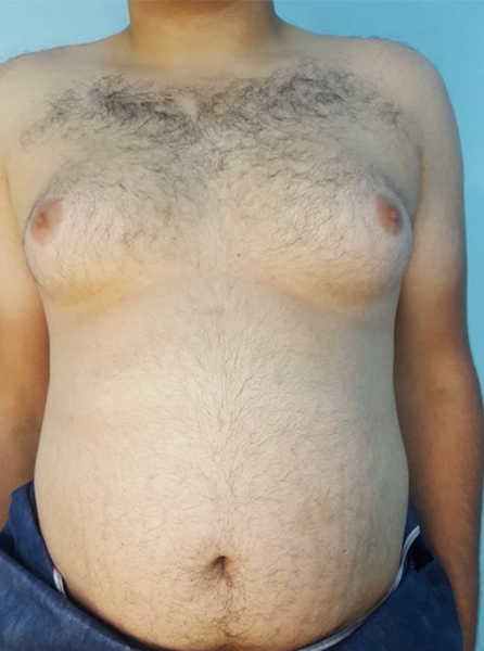 Male Breast Reduction after Dubai — natural outcome | Dr. Kotti (9)