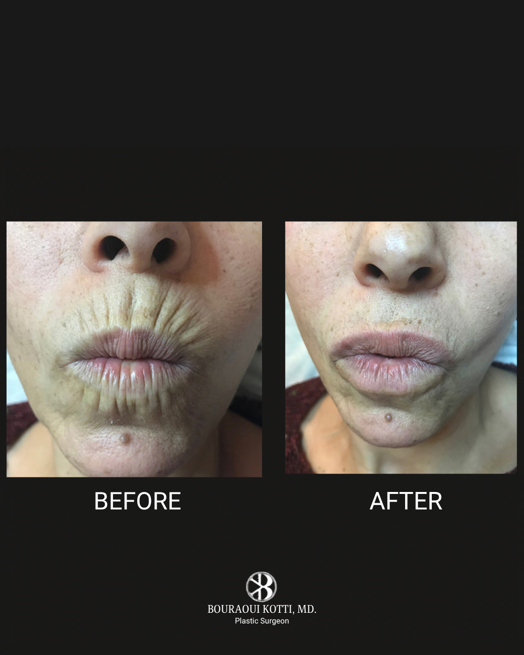 Lip Filler & Lip Augmentation before Dubai