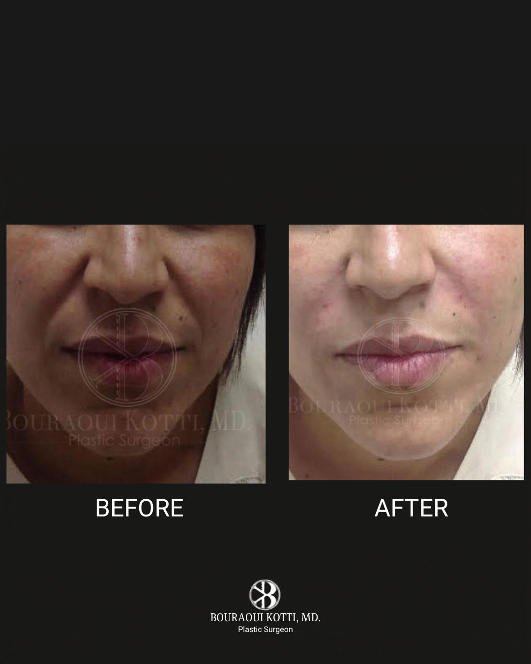 Lip Filler & Lip Augmentation after Dubai