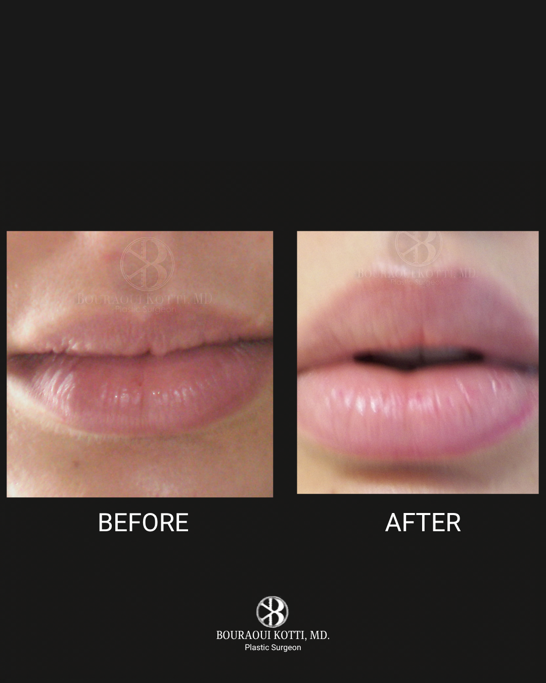 Lip Filler & Lip Augmentation before Dubai