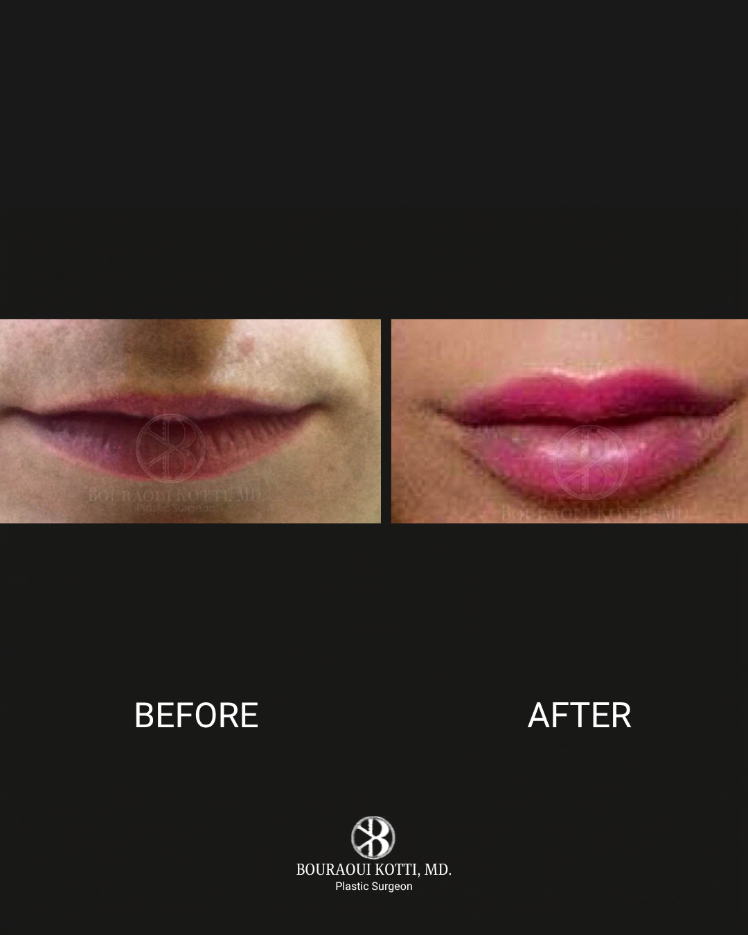 Lip Filler & Lip Augmentation after Dubai