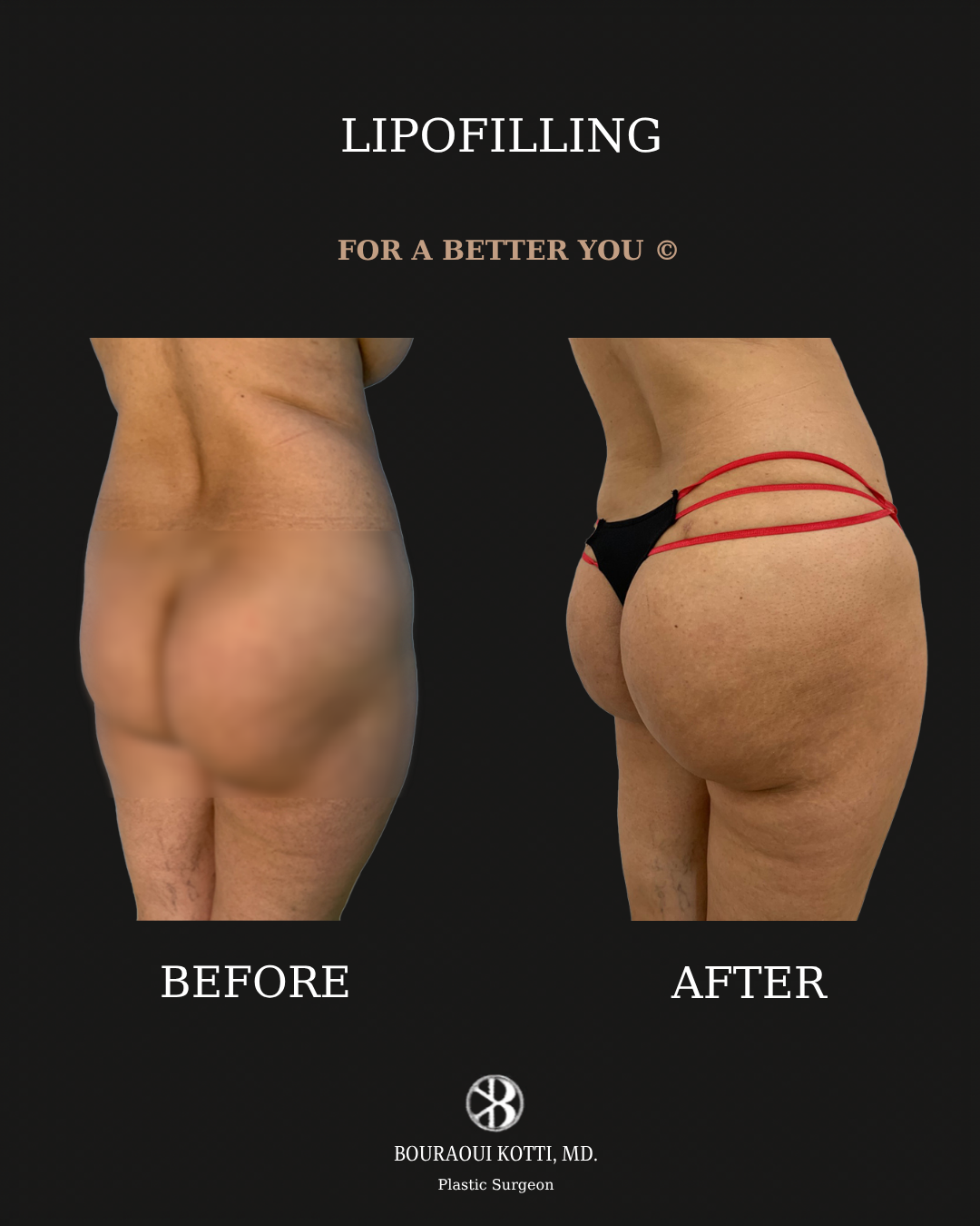 Липофилинг и бразильская подтяжка ягодиц (BBL) before Dubai