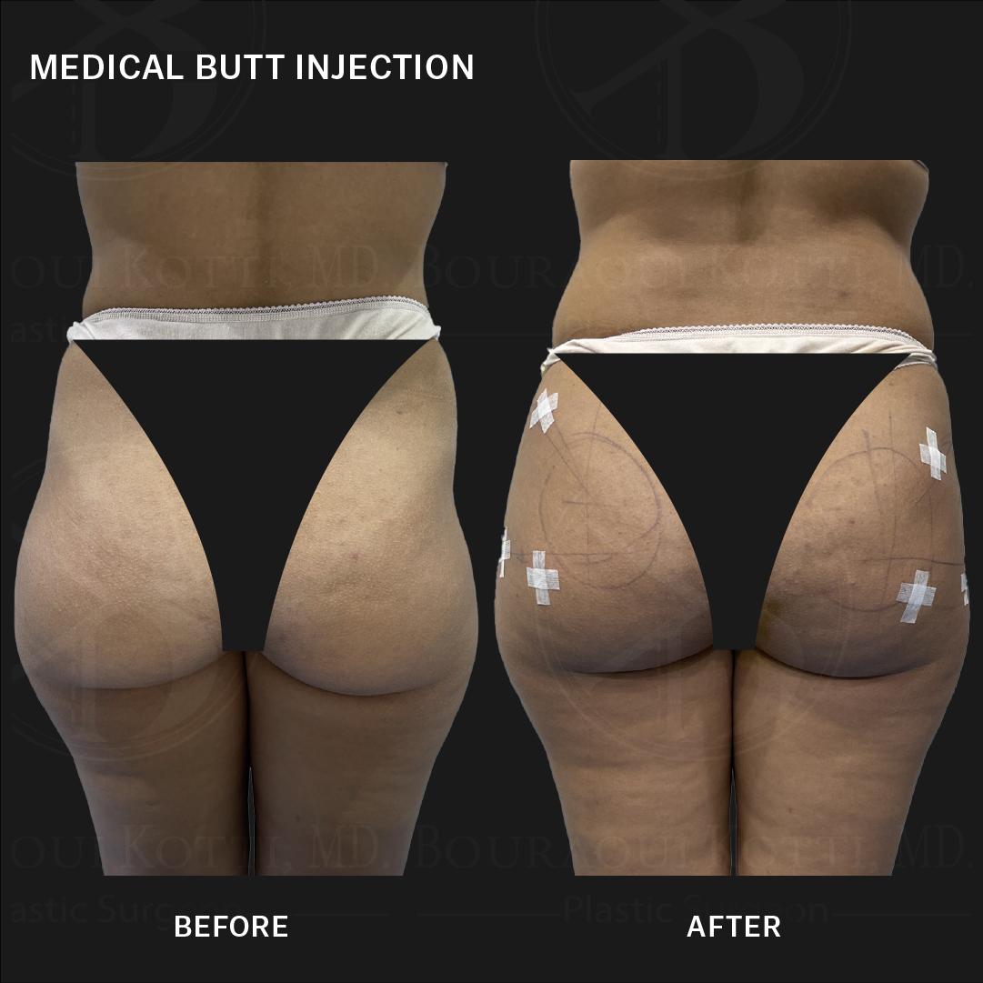 شفط الدهون after Dubai — natural outcome | Dr. Kotti (133)