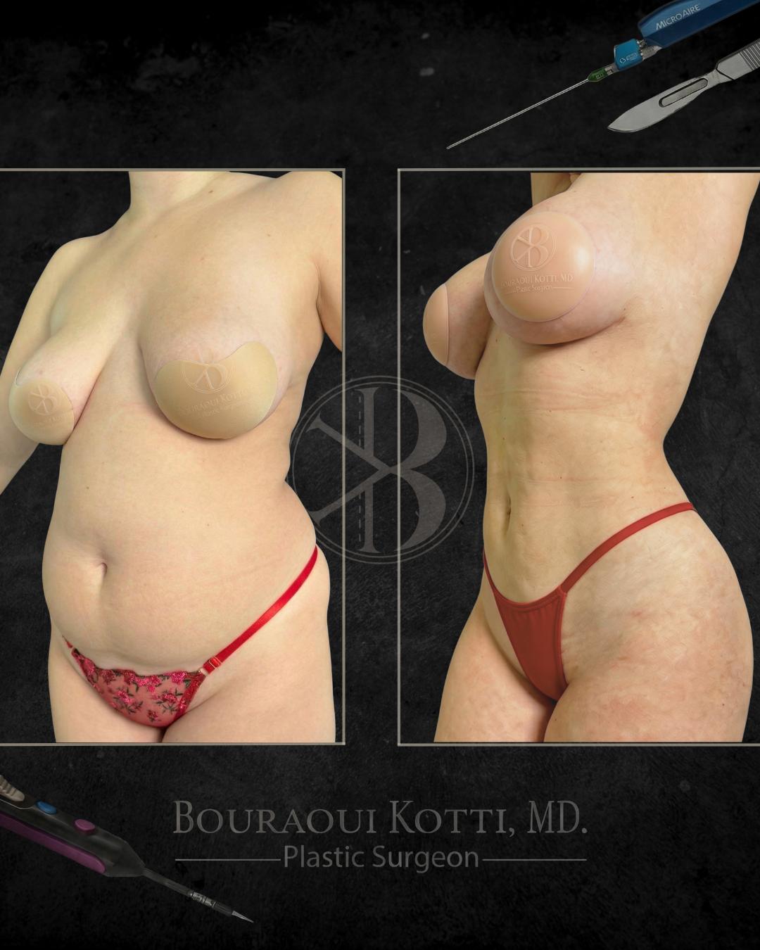 شفط الدهون before Dubai — natural outcome | Dr. Kotti (134)