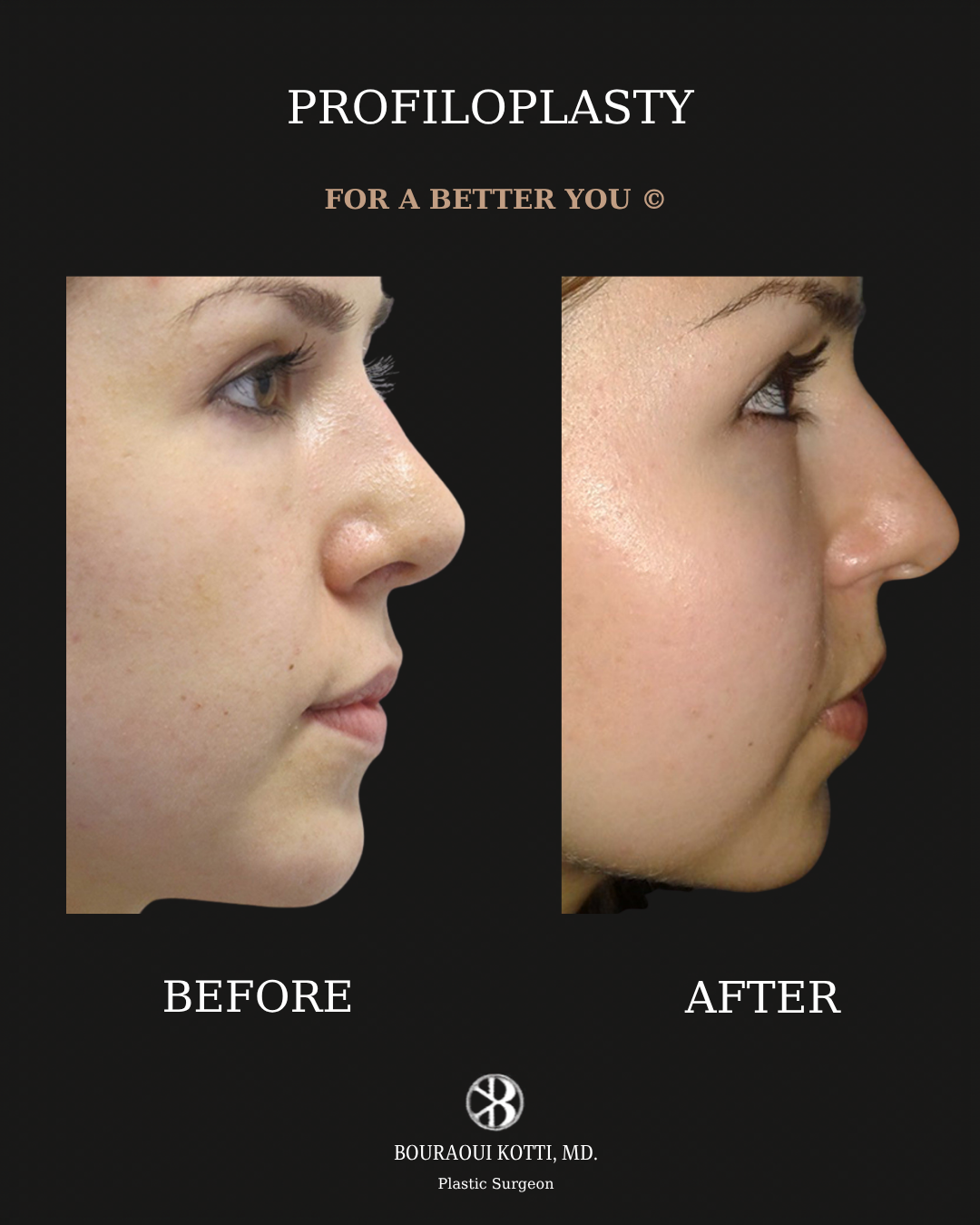 Profiloplasty — Non-Surgical Facial Contouring before Dubai