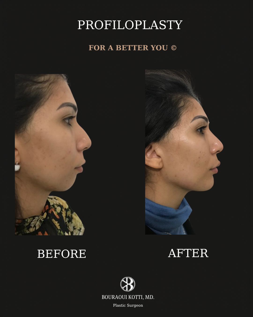 Profiloplasty — Non-Surgical Facial Contouring after Dubai
