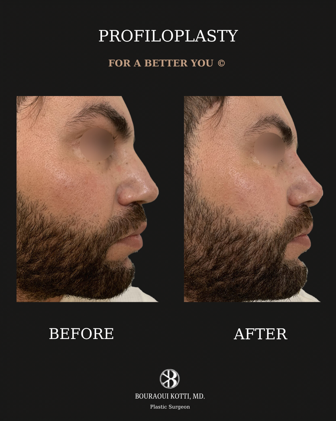 Profiloplasty — Non-Surgical Facial Contouring before Dubai