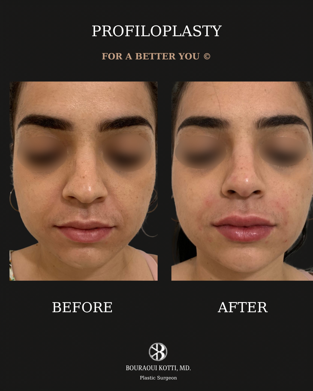 Profiloplasty — Non-Surgical Facial Contouring before Dubai