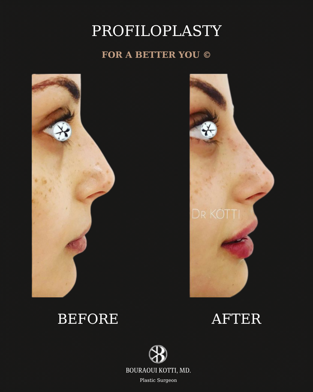 Profiloplasty — Non-Surgical Facial Contouring after Dubai