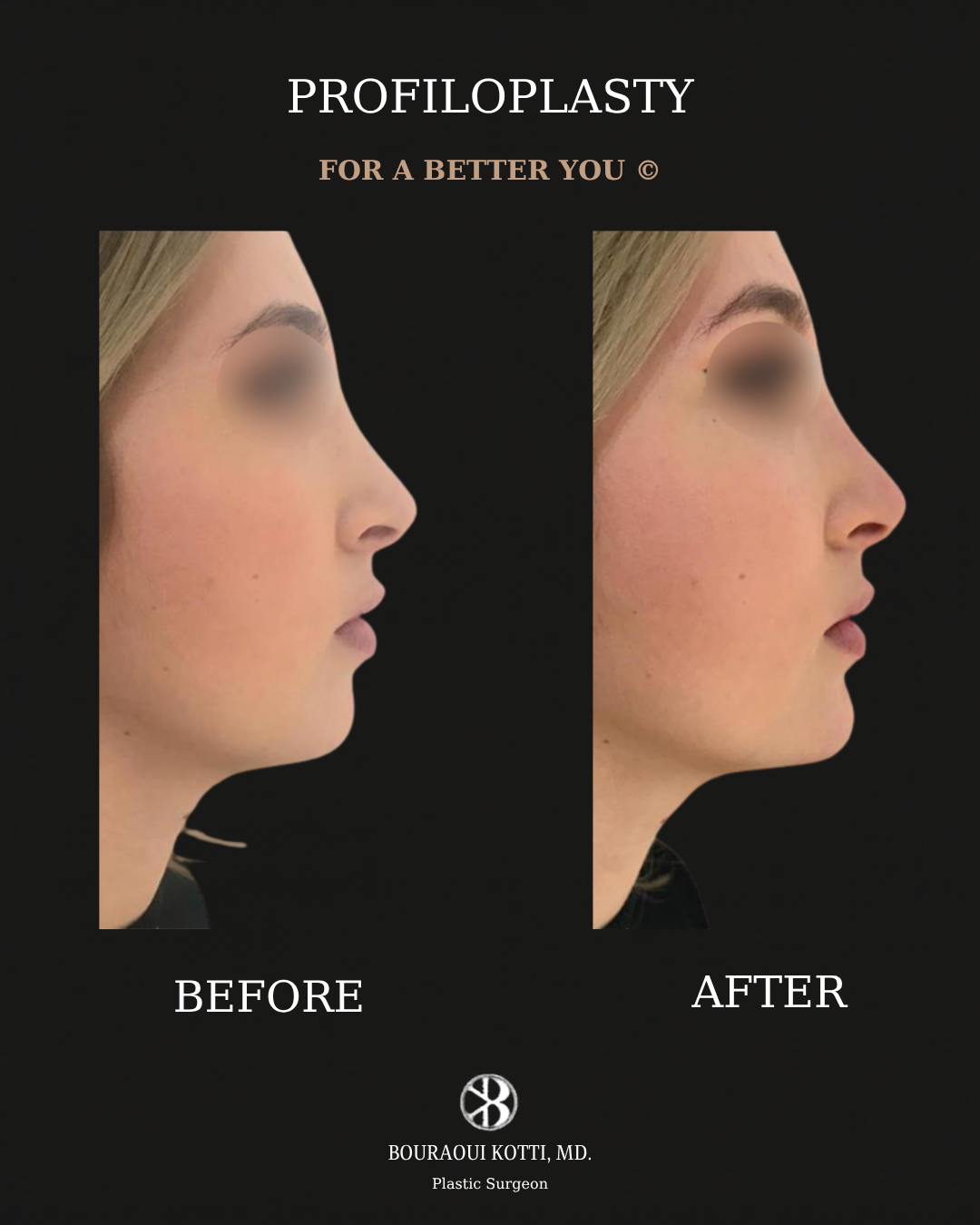 Profiloplasty — Non-Surgical Facial Contouring before Dubai