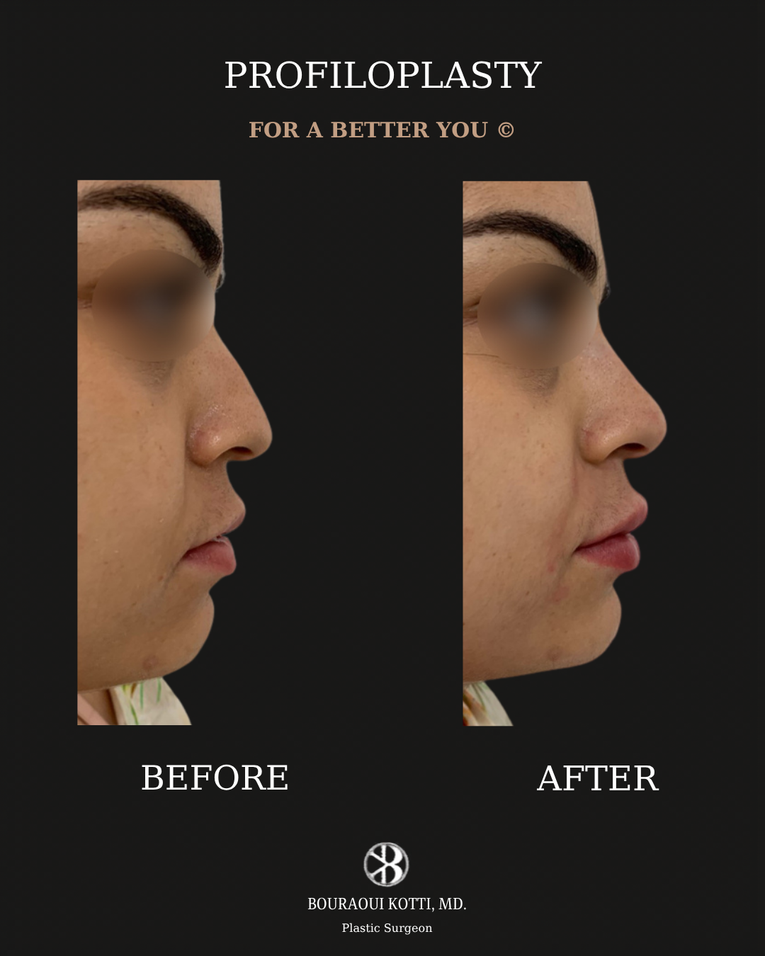 Profiloplasty — Non-Surgical Facial Contouring after Dubai