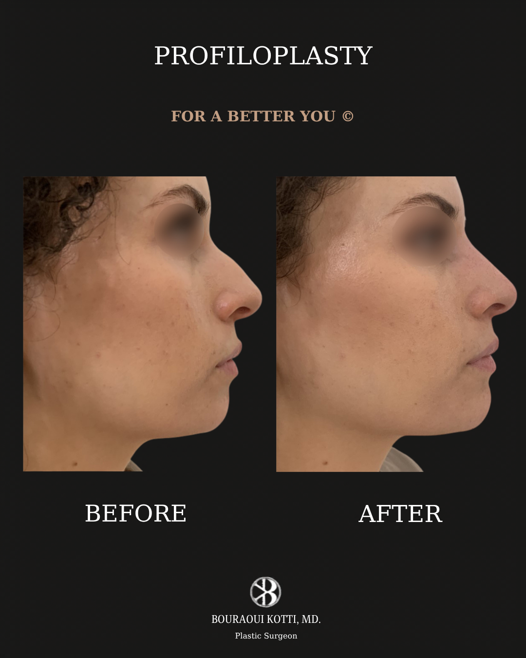 Profiloplasty — Non-Surgical Facial Contouring before Dubai