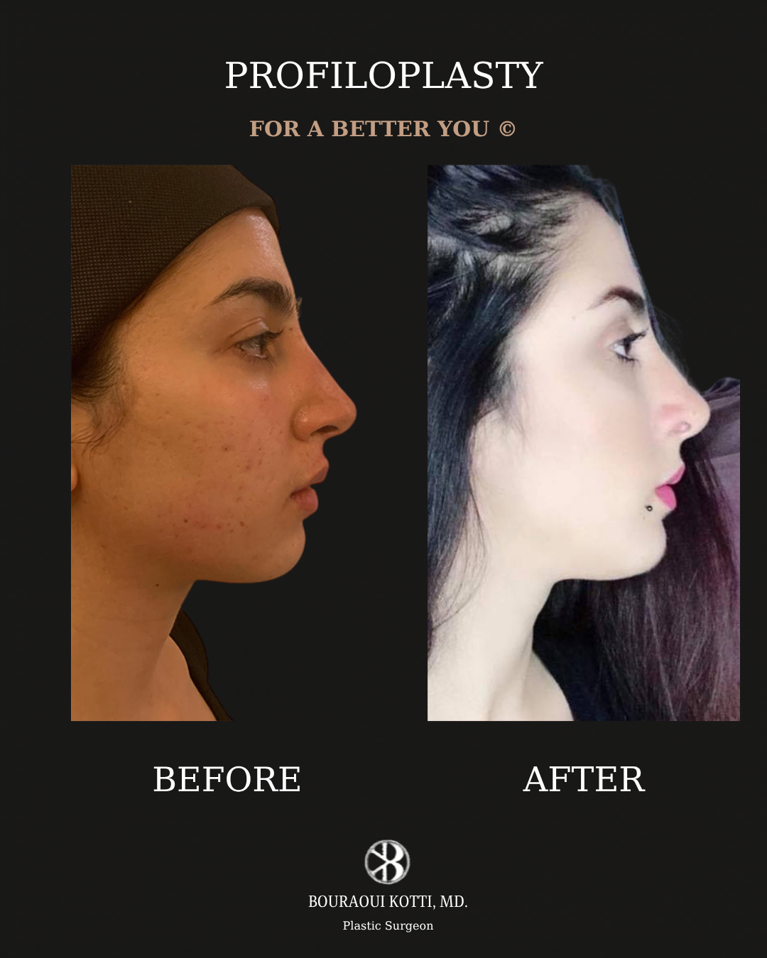 Profiloplasty — Non-Surgical Facial Contouring after Dubai