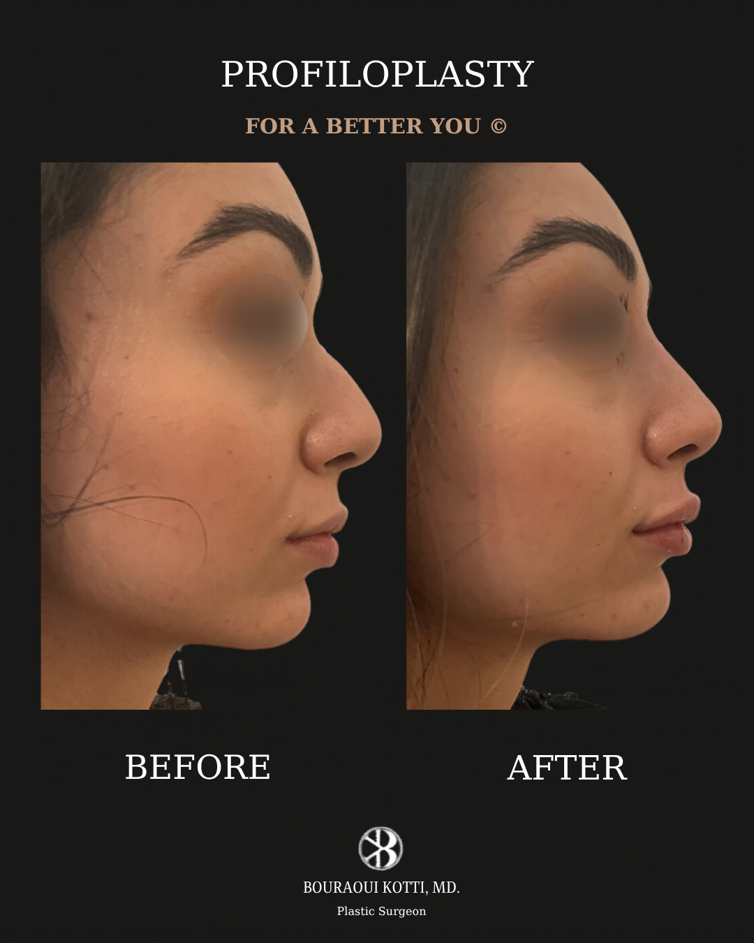 Profiloplasty — Non-Surgical Facial Contouring before Dubai