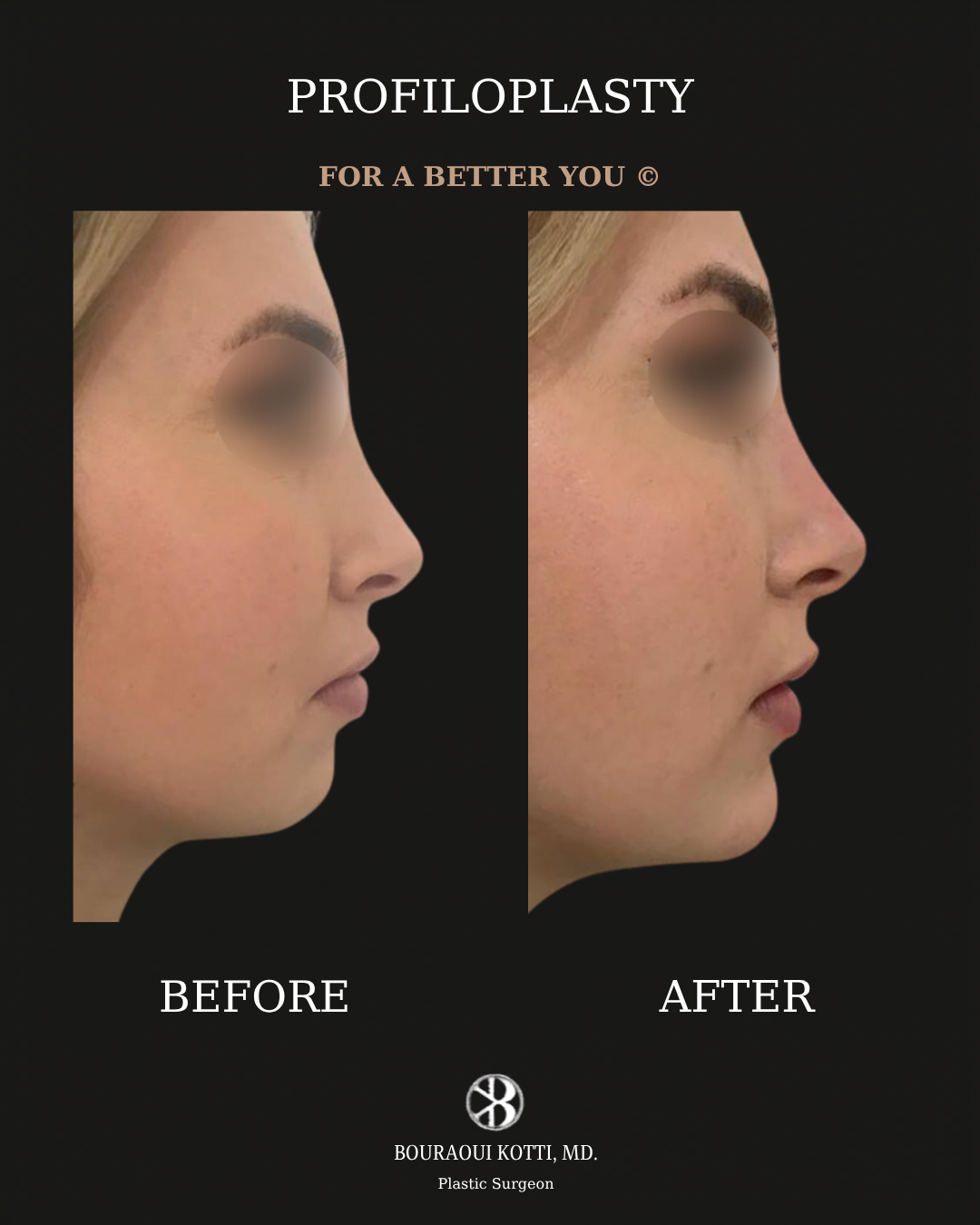 Profiloplasty — Non-Surgical Facial Contouring after Dubai