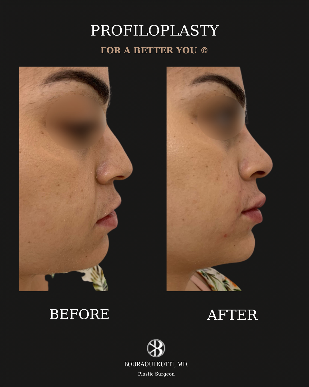 Profiloplasty — Non-Surgical Facial Contouring before Dubai