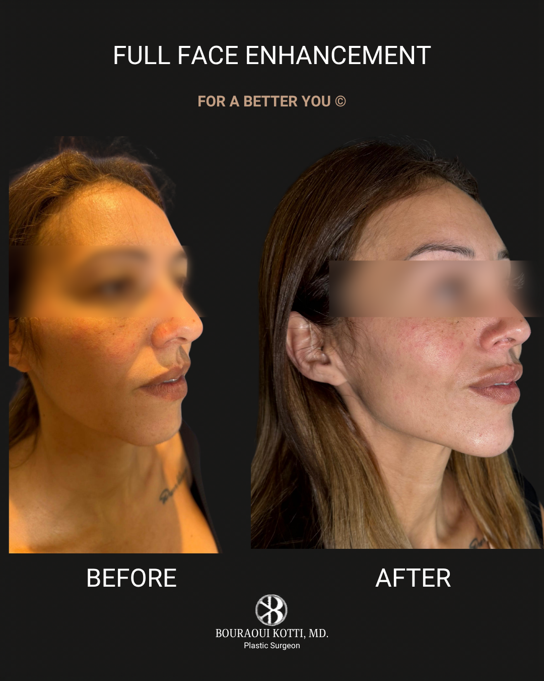 Profiloplasty — Non-Surgical Facial Contouring after Dubai