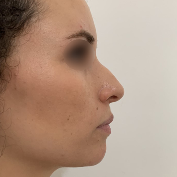 profiloplasty before Dubai — natural outcome | Dr. Kotti (5)