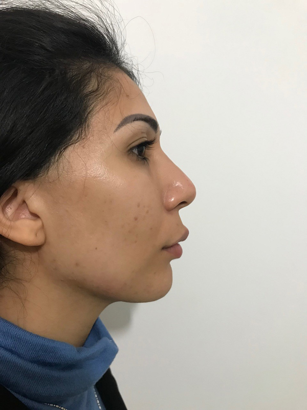 profiloplasty after Dubai — natural outcome | Dr. Kotti (6)