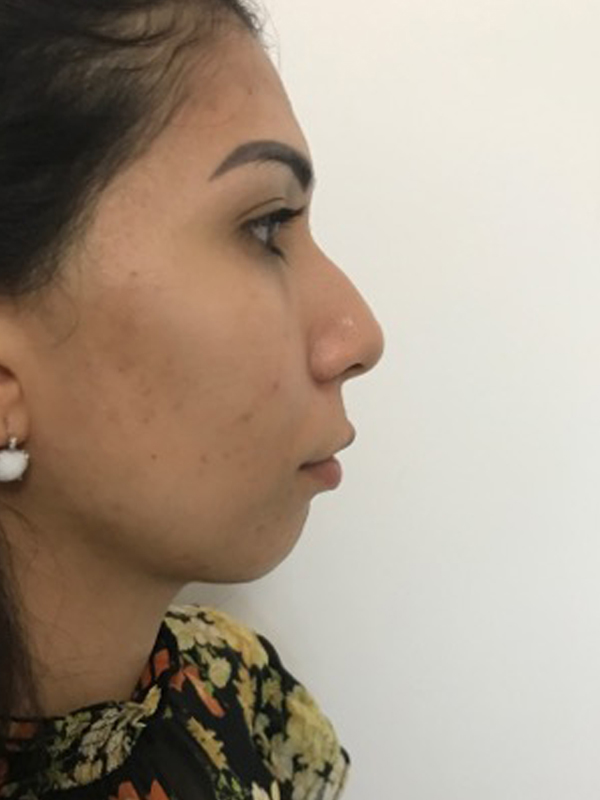profiloplasty before Dubai — natural outcome | Dr. Kotti (6)