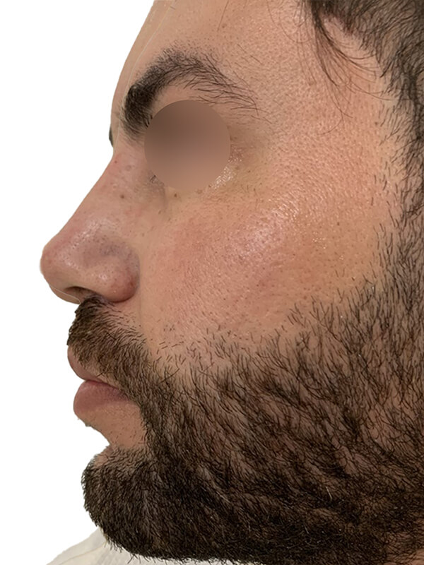 profiloplasty after Dubai — natural outcome | Dr. Kotti (7)