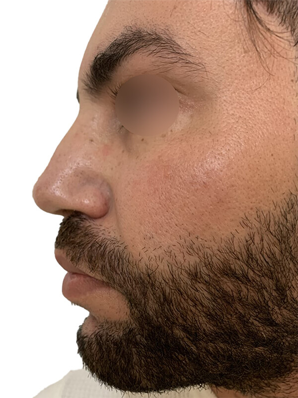 profiloplasty before Dubai — natural outcome | Dr. Kotti (7)