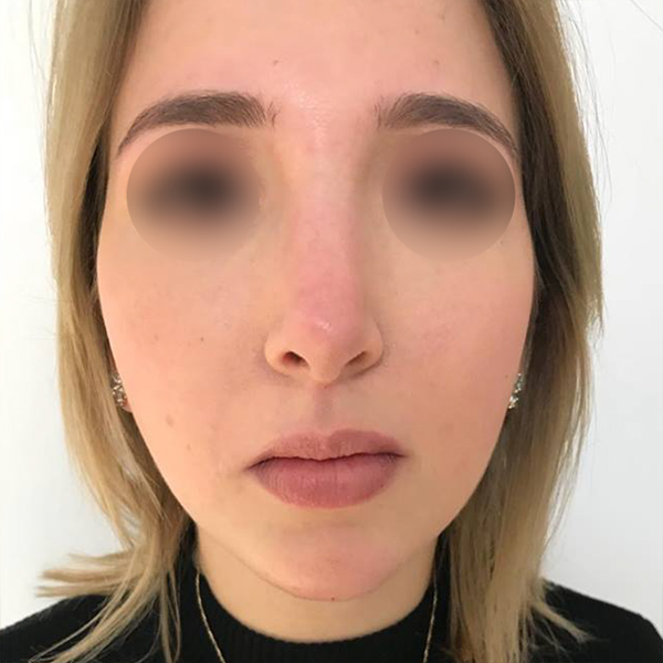 profiloplasty after Dubai — natural outcome | Dr. Kotti (8)