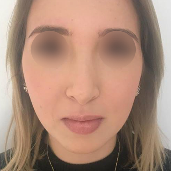 profiloplasty before Dubai — natural outcome | Dr. Kotti (8)