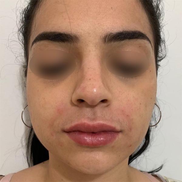 profiloplasty after Dubai — natural outcome | Dr. Kotti (9)