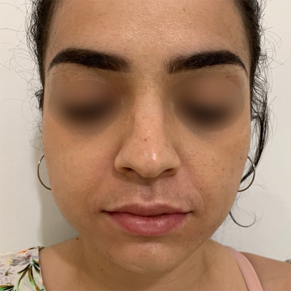 profiloplasty before Dubai — natural outcome | Dr. Kotti (9)