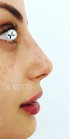 profiloplasty after Dubai — natural outcome | Dr. Kotti (10)
